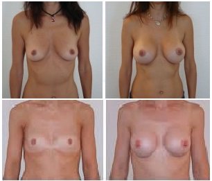 photo augmentation mammaire Tunisie avant ou après