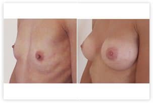 photo augmentation mammaire Tunisie avant et après