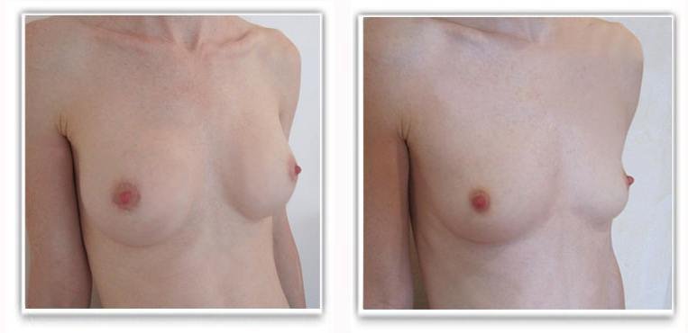 photo chirurgie mammaire Tunisie avant et après